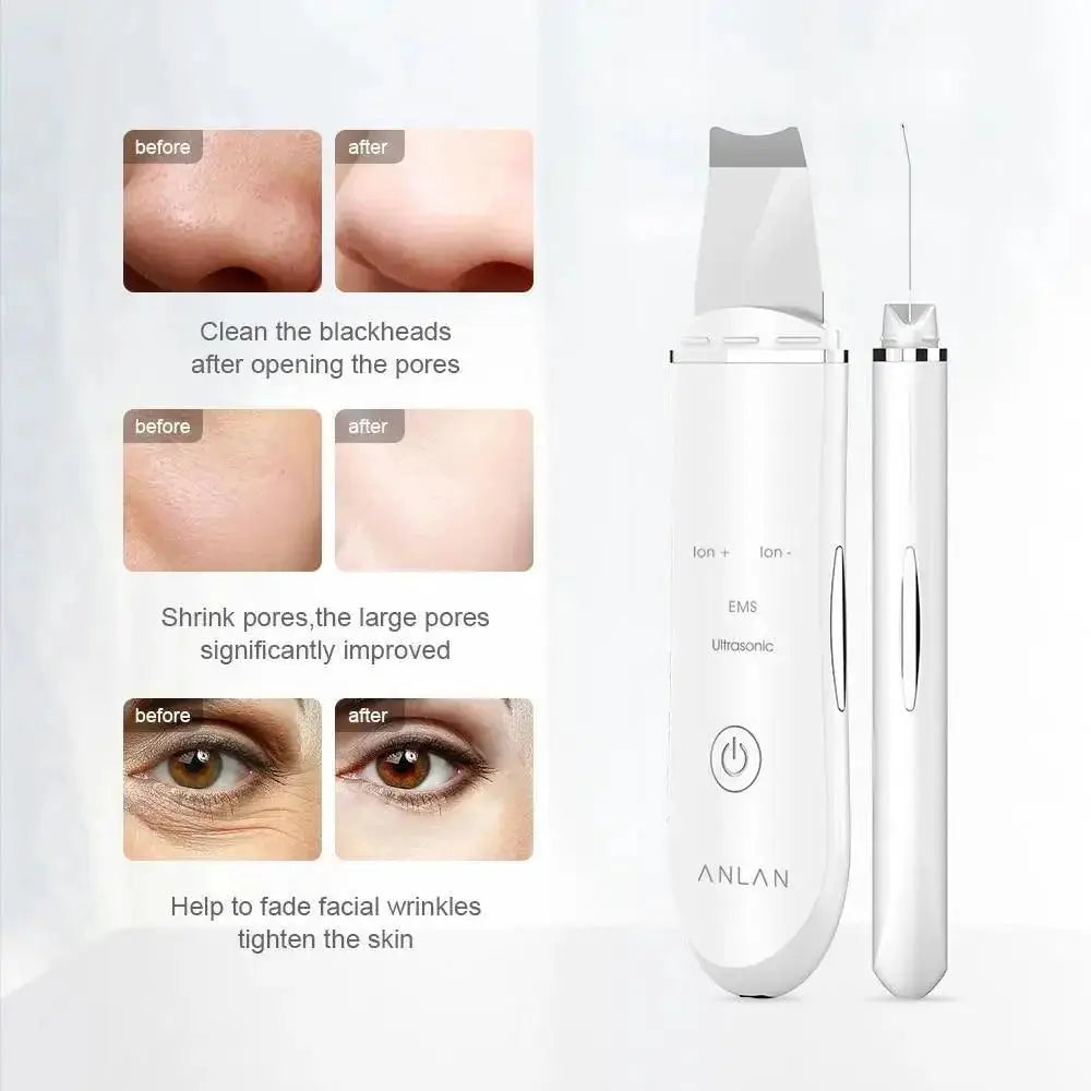 Ultrasonic Derma Skin Scrubber Pen for Face