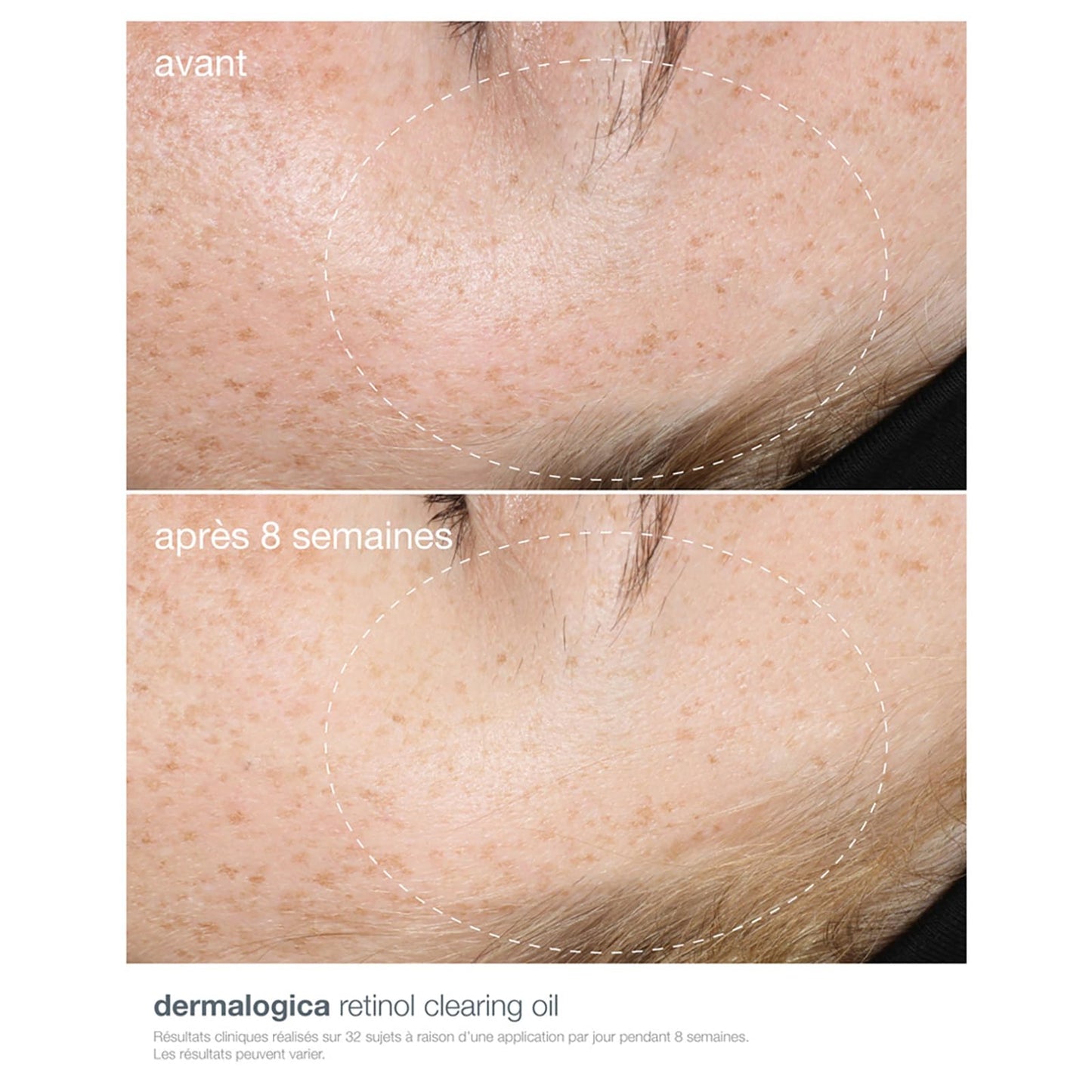 Dermalogica Retinol Clearing Oil acne treatment night oil on freckled cheek; 8 weeks later on Tampa Home & Garden Store