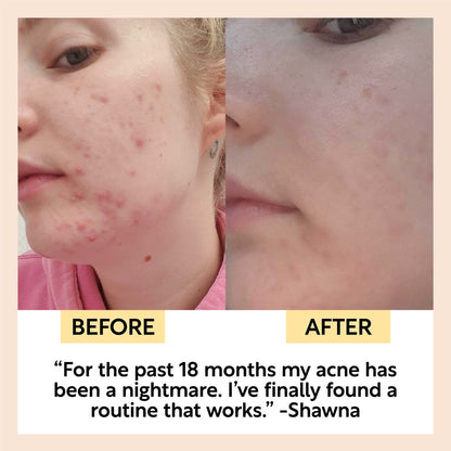 Double Cleansing Duo by UpCircle — before and after acne-prone skin, clearer complexion on Tampa Home & Garden Store