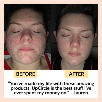 UpCircle Cleanse, Tone + Moisturize Set skincare kit, before and after acne photo on Tampa Home & Garden Store