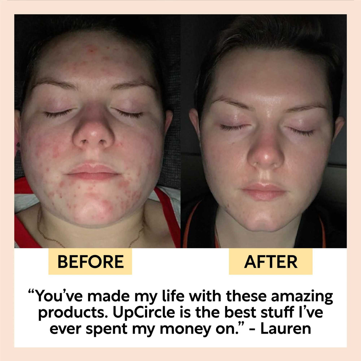 Double Cleansing Duo UpCircle; two-panel before and after acne-prone to clear skin on Tampa Home & Garden Store