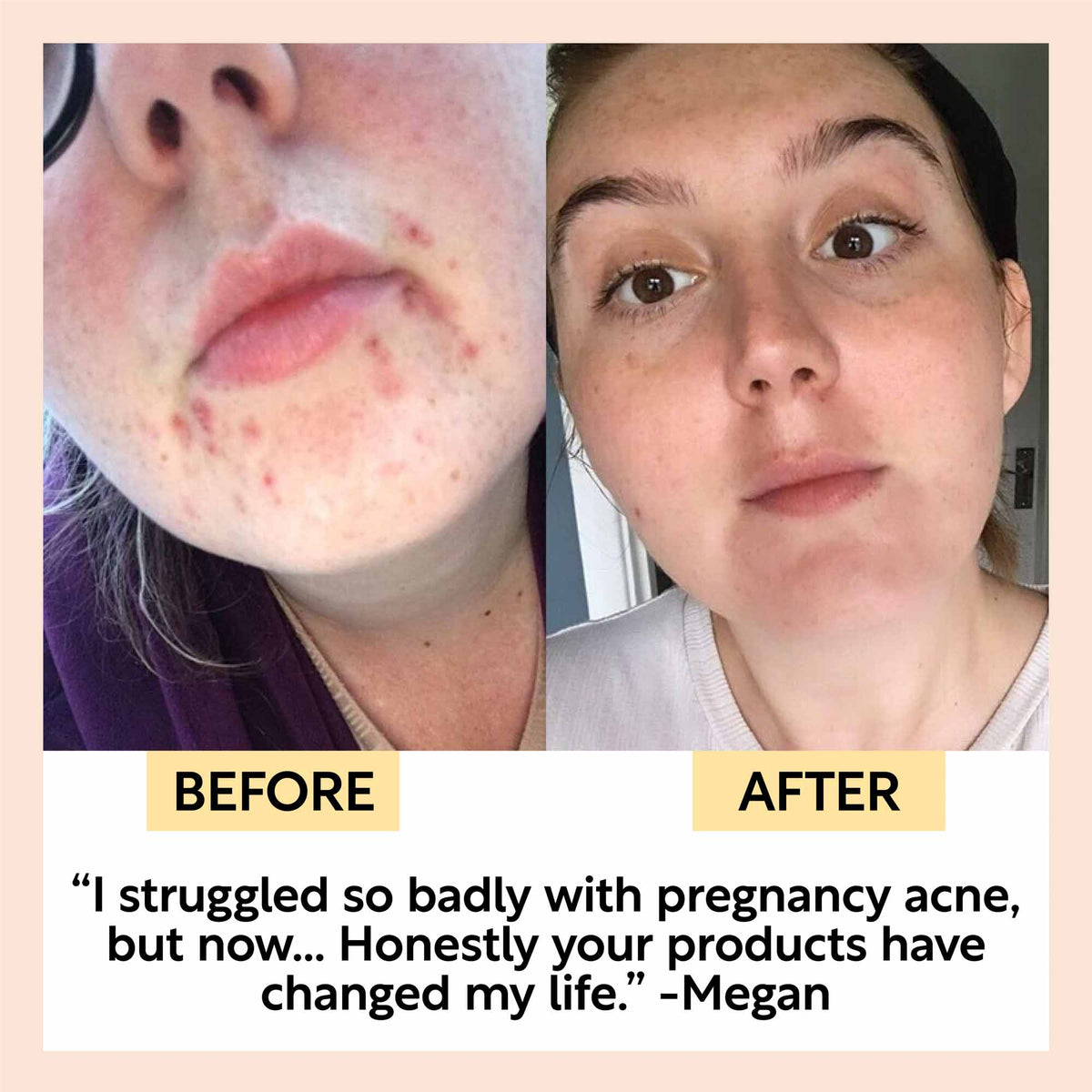 UpCircle Day + Night Hydration Set skincare collage showing before-after acne improvement on Tampa Home & Garden Store
