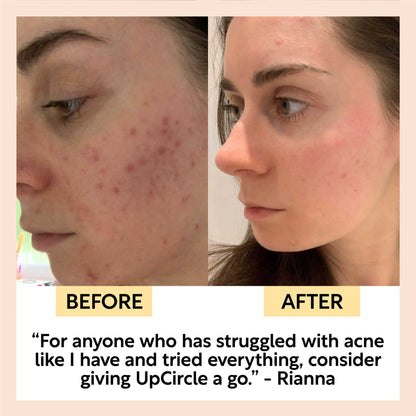 UpCircle Cleanse, Tone + Moisturize Set for acne-prone skin shown in before/after split image on Tampa Home & Garden Store