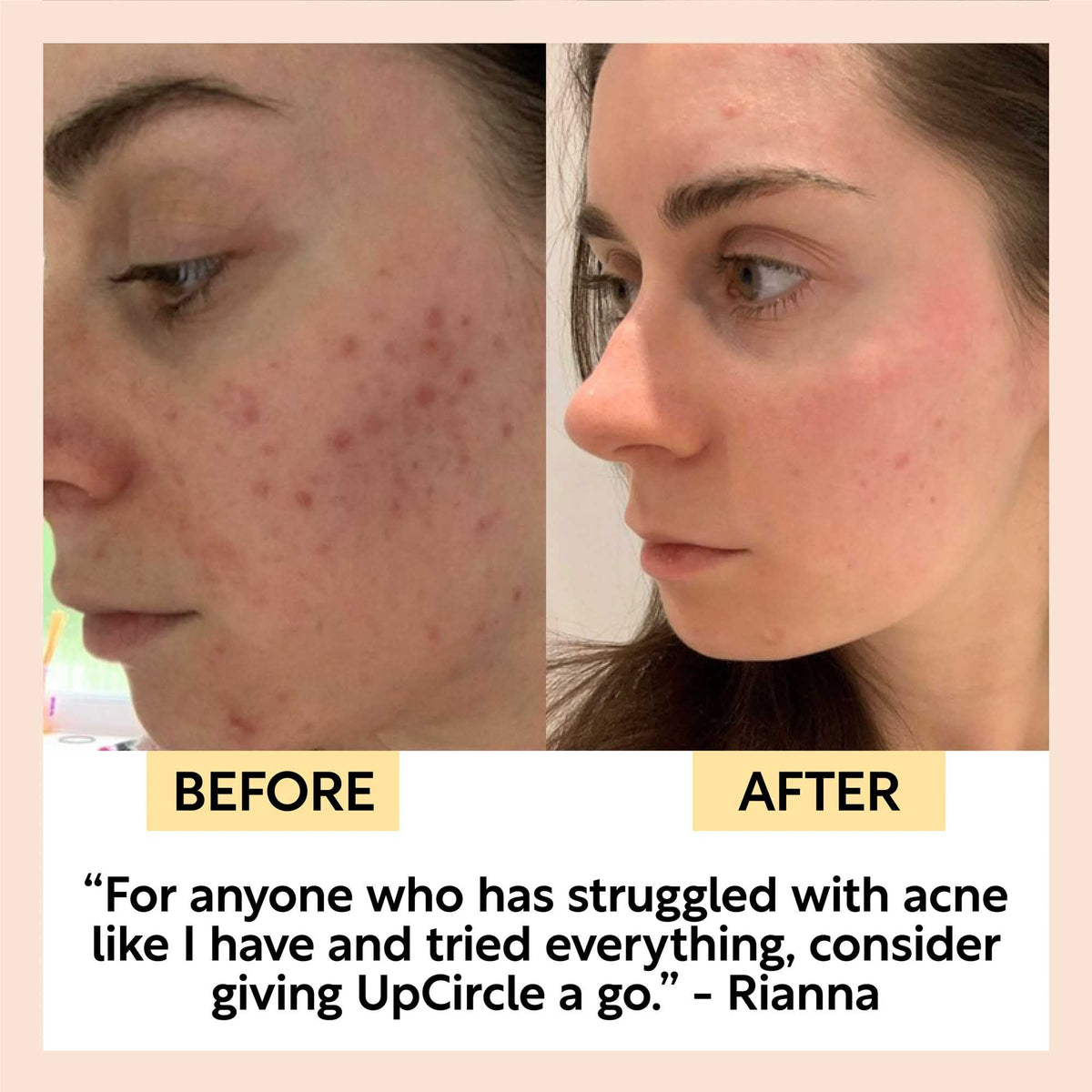 UpCircle Travel-Size Skincare Bundle gifting kit; before and after acne improvement collage on Tampa Home & Garden Store