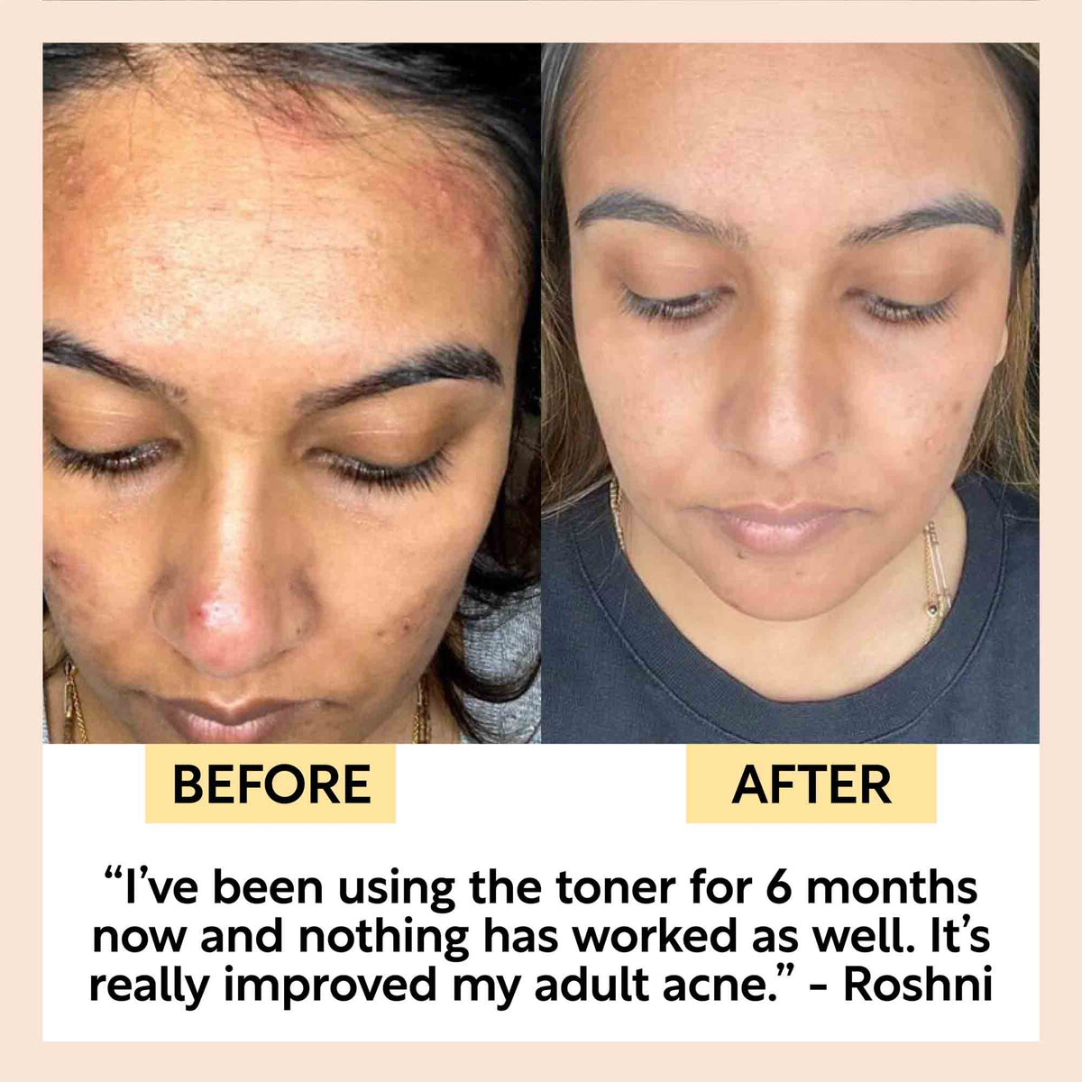 Face Toner with Hyaluronic Acid by UpCircle before‑after acne improvement collage showing clearer skin on the right on Tampa Home & Garden Store