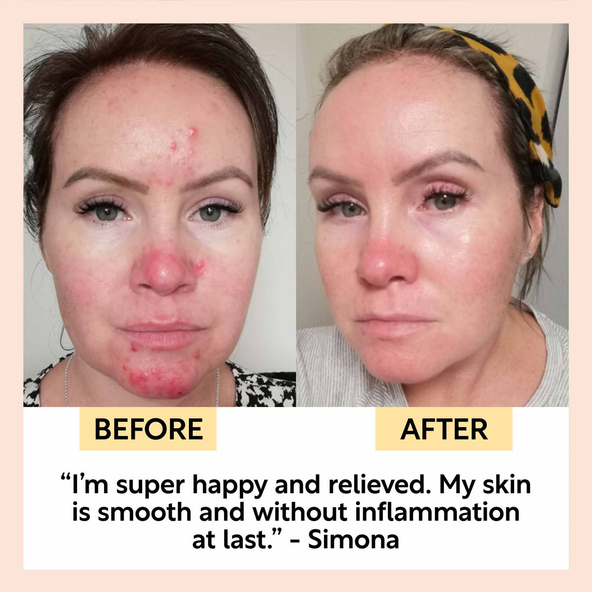 UpCircle Day + Night Hydration Set two-panel before-after acne improvement on Tampa Home & Garden Store