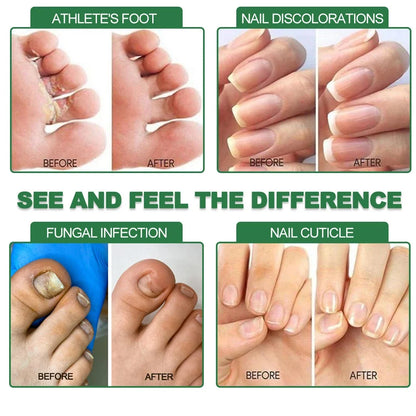 7 Days Fungal Nail Treatment Serum collage with before/after for athlete's foot and nails on Tampa Home & Garden Store