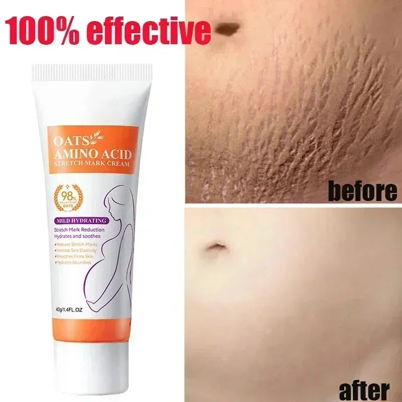 Silcy Skin stretch mark cream tube orange label white pack beside before after skin photos on Tampa Home & Garden Store