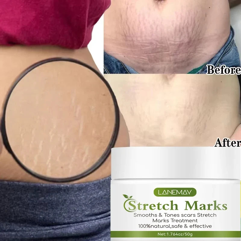 Stretch Marks Cream LANEMAY jar with before and after abdomen photos, maternity skin care on Tampa Home & Garden Store