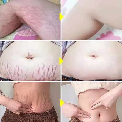 Stretch Marks Remover Serum Silcy Skin collage belly before after results on Tampa Home & Garden Store