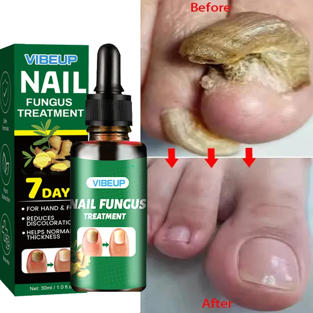 VIBEUP Nail Fungus Treatment serum bottle with green box before/after toenail fungus improvement on Tampa Home & Garden Store
