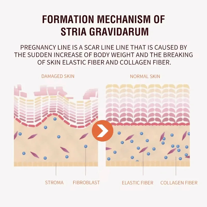 Silcy Skin maternity stretch marks cream infographic shows striae gravidarum formation on Tampa Home & Garden Store