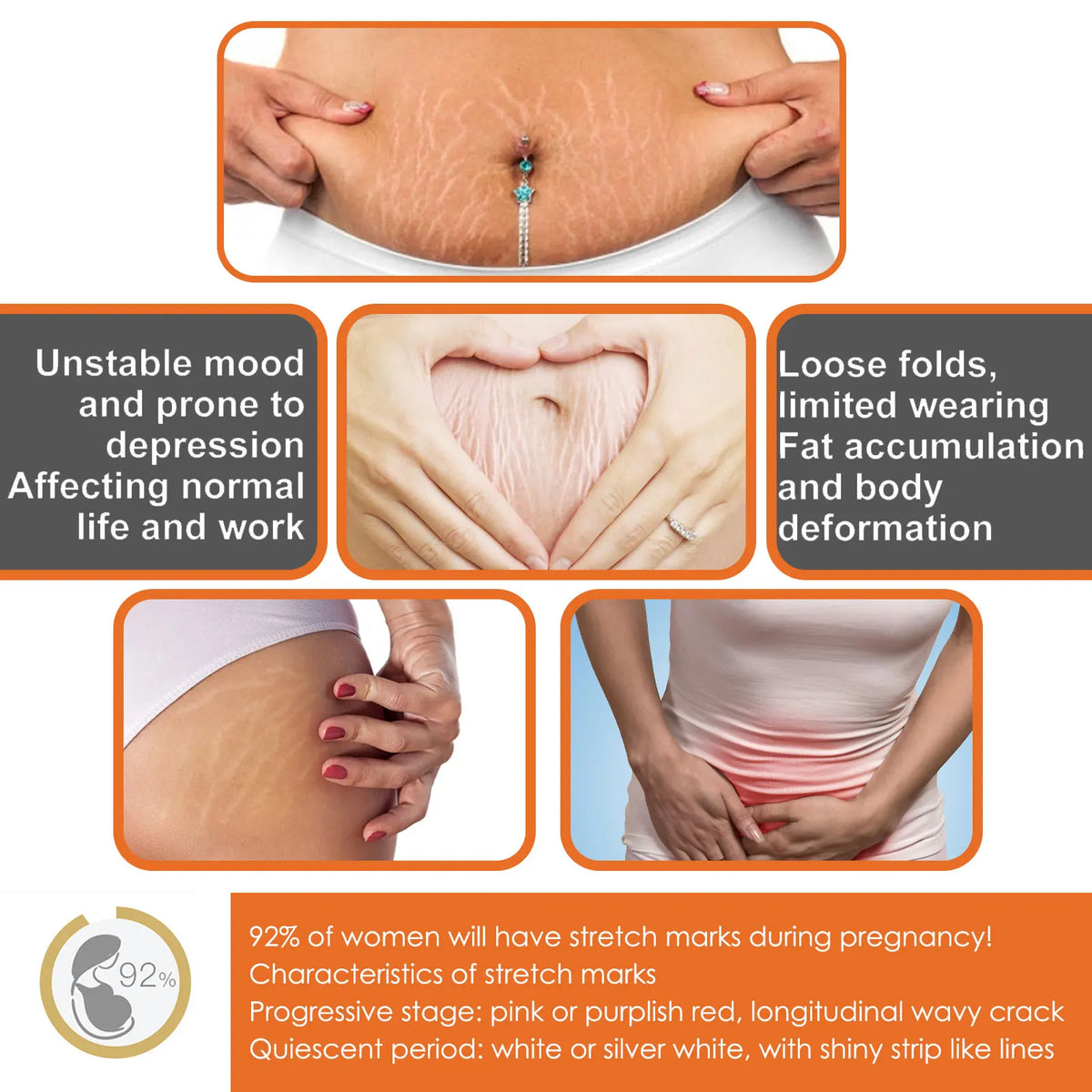 Silcy Skin 100g stretch marks removal cream for pregnancy on belly showing visible stretch marks on Tampa Home & Garden Store