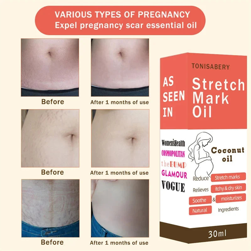 Stretch Marks Oil by Silcy Skin orange box; three before/after skin photos show 1 month of use on Tampa Home & Garden Store