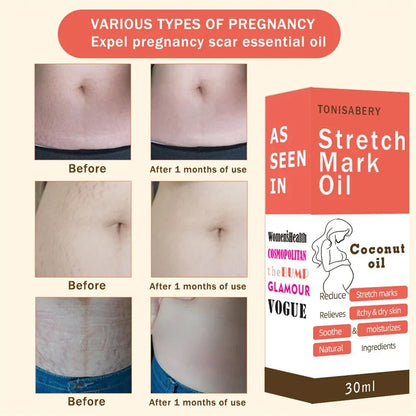 Stretch Marks Oil by Silcy Skin orange box; three before/after skin photos show 1 month of use on Tampa Home & Garden Store