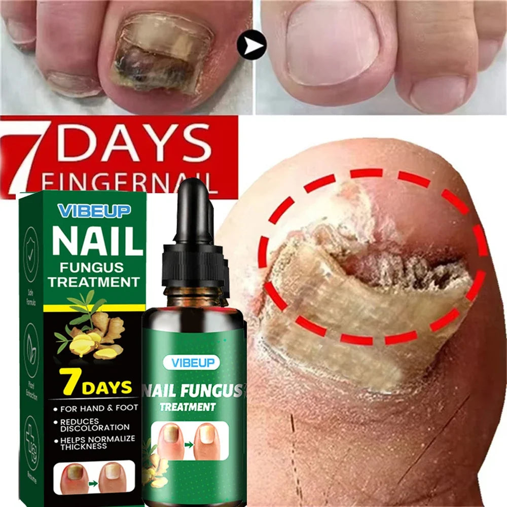 2pc VIBEUP Nail Fungus Treatment serum bottle and box; diseased toenail circled red for repair on Tampa Home & Garden Store