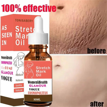 Silcy Skin Stretch Mark Oil bottle with dropper, 30ml amber glass, orange label packaging on Tampa Home & Garden Store