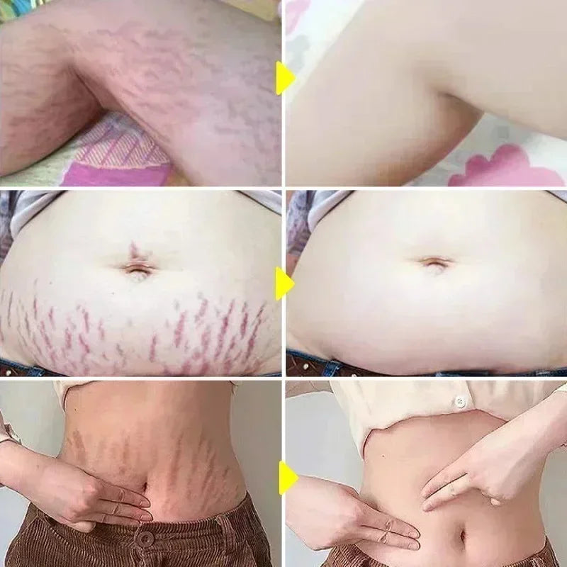 Silcy Skin stretch marks removal cream; before/after collage shows faded marks on abdomen, 6-image on Tampa Home & Garden Store