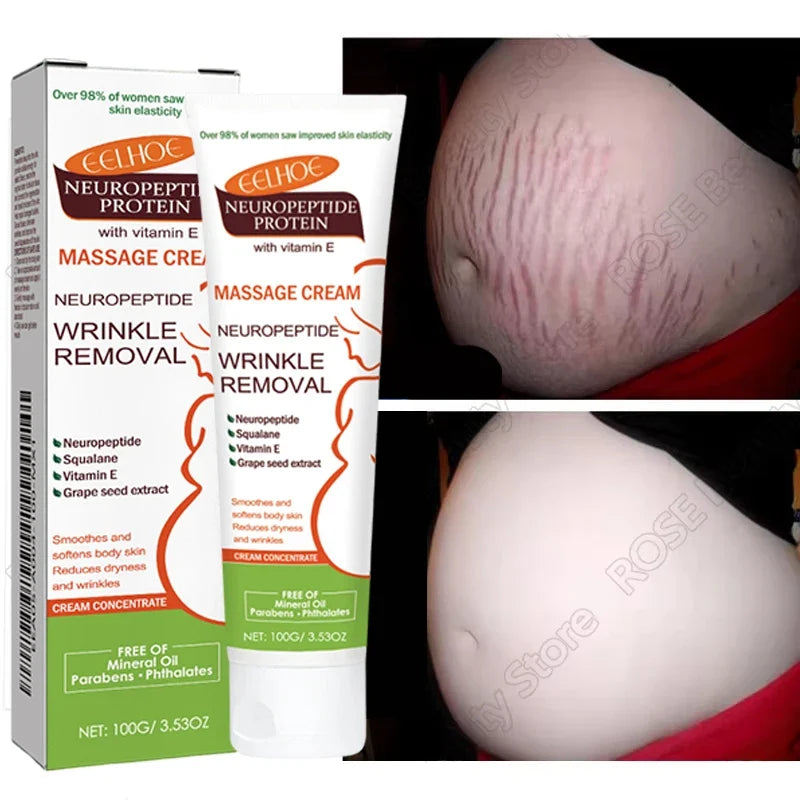Stretch marks removal cream Silcy Skin 100g two tubes with neuropeptide for pregnancy belly image on Tampa Home & Garden Store