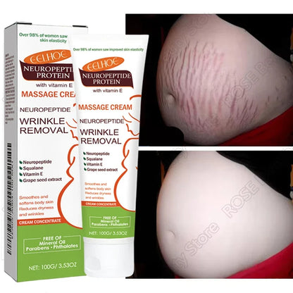 Stretch marks removal cream Silcy Skin 100g two tubes with neuropeptide for pregnancy belly image on Tampa Home & Garden Store