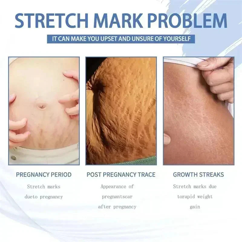 Silcy Skin pregnancy stretch marks cream showing pregnancy, post-pregnancy and growth marks on Tampa Home & Garden Store