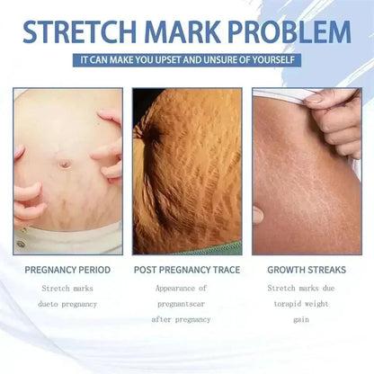 Silcy Skin Maternity Stretch Mark Removal Cream; belly, back, and arm stretch marks on Tampa Home & Garden Store