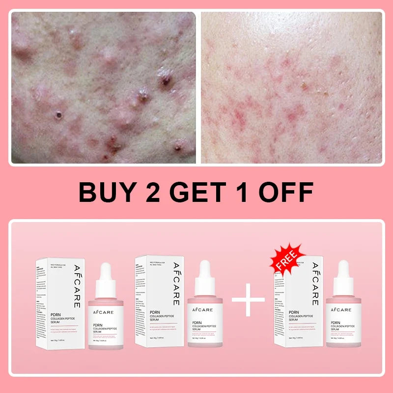 Collagen Peptide Facial Serum by Silcy Skin; pink boxed dropper bottles; acne before/after on Tampa Home & Garden Store
