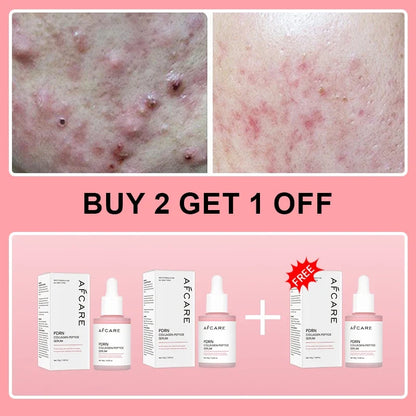 Collagen Peptide Facial Serum by Silcy Skin; pink boxed dropper bottles; acne before/after on Tampa Home & Garden Store