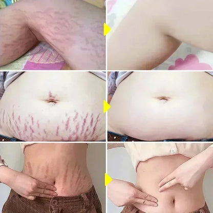 Silcy Skin Maternity Stretch Mark Removal Cream for abdomen permanent firming skin care on Tampa Home & Garden Store