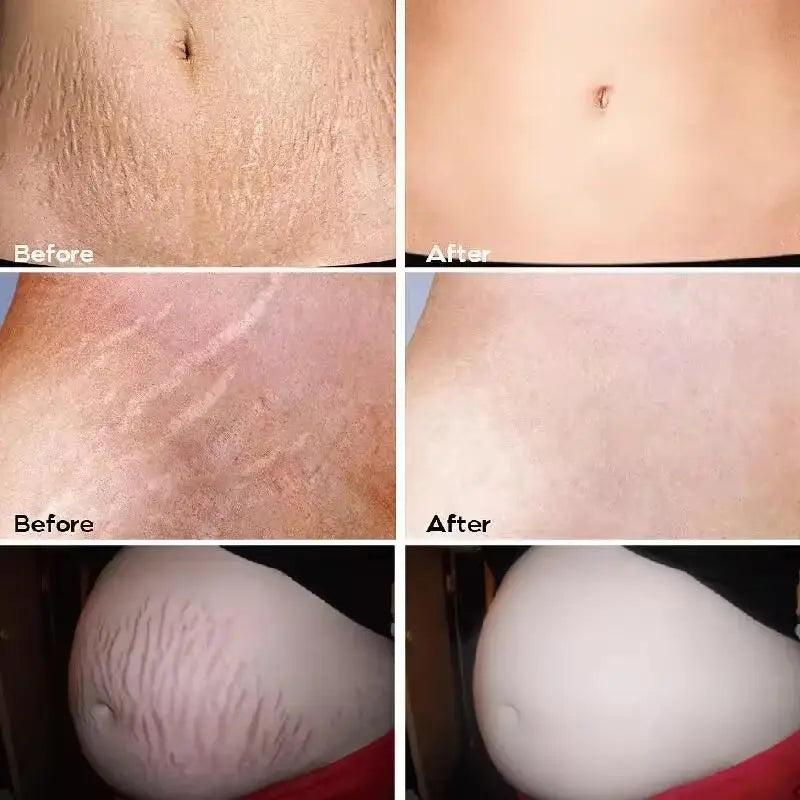 Stretch Marks Removal Cream by Silcy Skin showing maternity belly before and after on Tampa Home & Garden Store