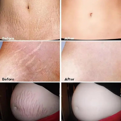 Stretch Marks Removal Cream by Silcy Skin showing maternity belly before and after on Tampa Home & Garden Store