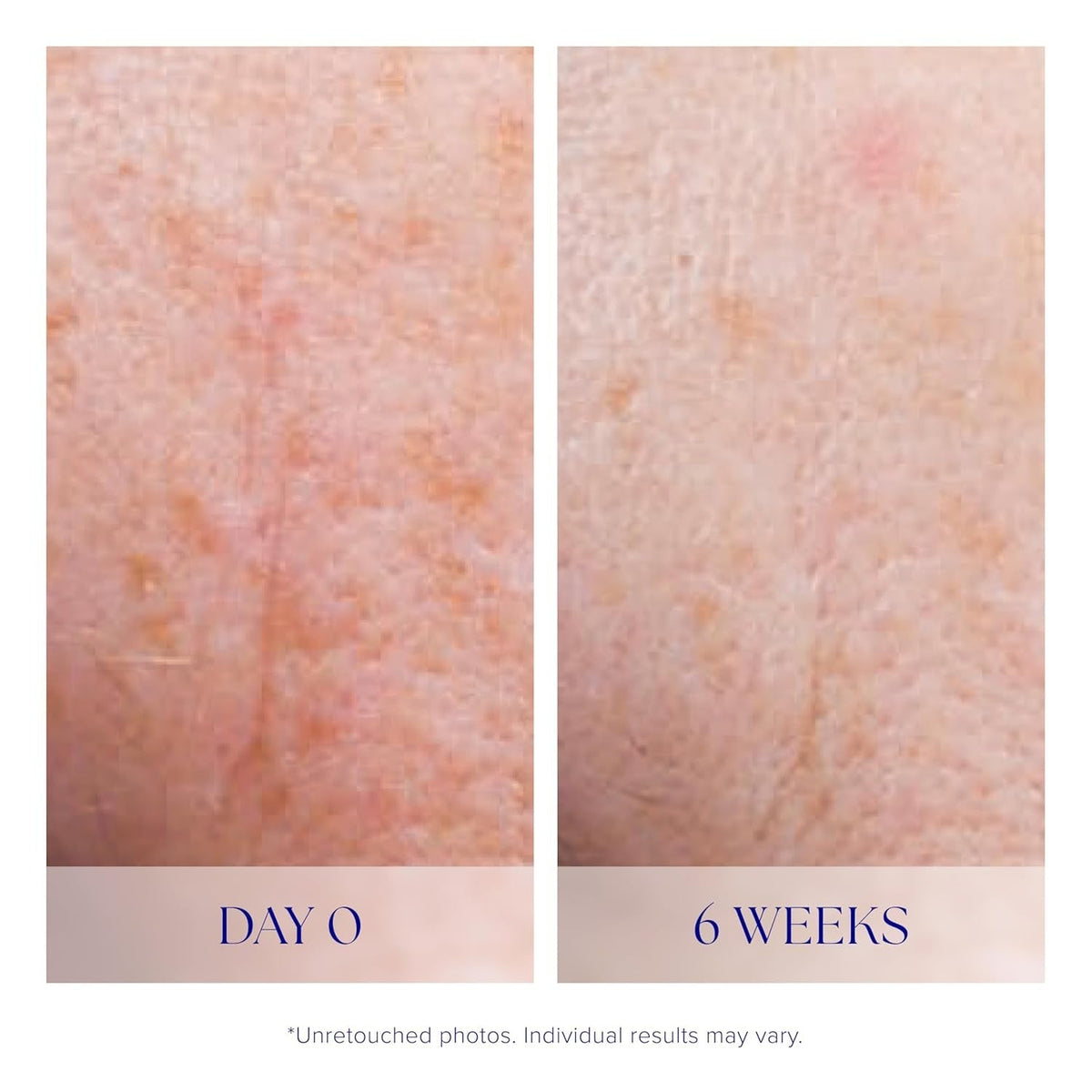 iS Clinical Active Serum face serum by Nava Beauty; Day 0 vs 6 weeks skin improvement on Tampa Home & Garden Store