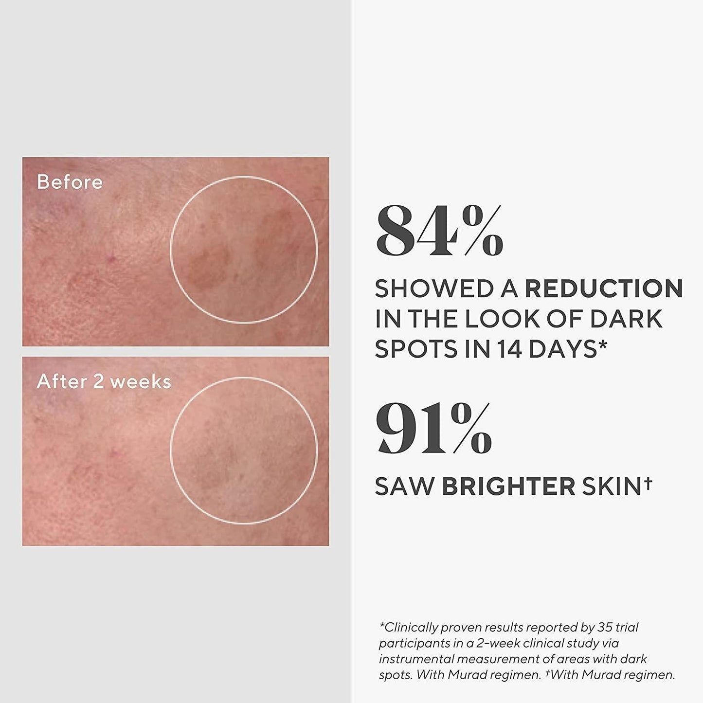 DR.Murad Dark Spot Correcting Serum before vs after 2 wks, 84% reduction, 91% brighter skin on Tampa Home & Garden Store