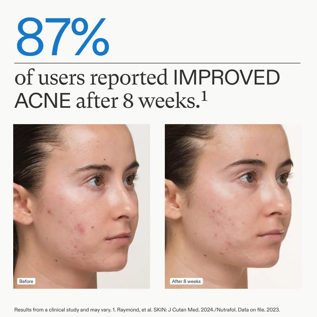 Nutrafol Clear Skin nutraceutical acne supplement by Nava Beauty 3-month supply before/after acne on Tampa Home & Garden Store