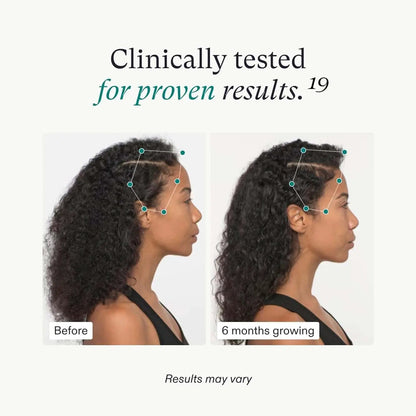 Nutrafol Women's Vegan Hair Growth Supplement Pack 3-Month Supply before/after hair growth on Tampa Home & Garden Store