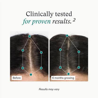 Nutrafol Women's Hair Growth by Nava Beauty, 3-mo supply, before vs 6 months growing scalp on Tampa Home & Garden Store