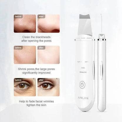 Ultrasonic Derma Skin Scrubber Pen for Face